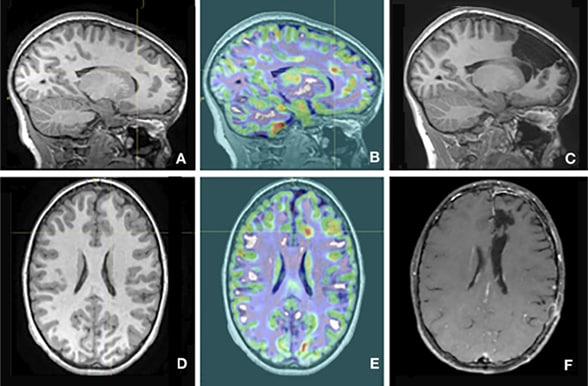 Morphometric MRI analysis for focal cortical dysplasia