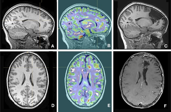 Análisis morfométrico de RMN para displasia cortical focal