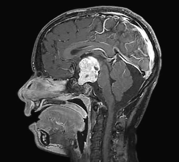 Uniformly enhancing lesion fills sellar and suprasellar spaces