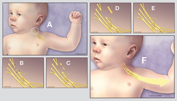 جراحة علاج إصابة الضفيرة العضدية في الأطفال حديثي الولادة