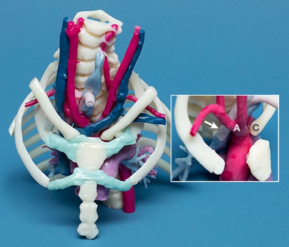 3D-printed model of a pediatric patient's airway