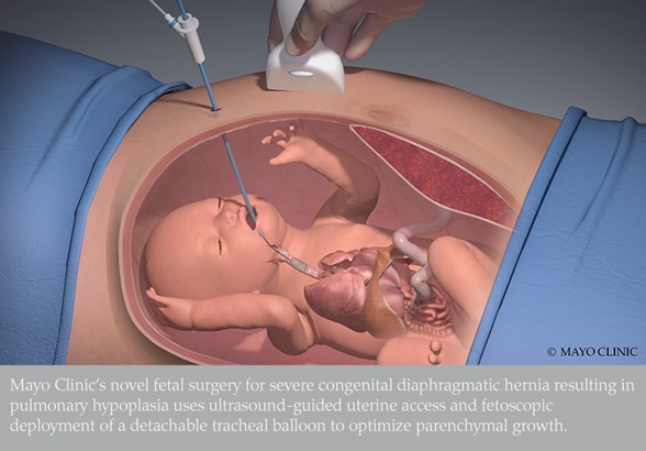Novel fetal surgery for congenital diaphragmatic hernia