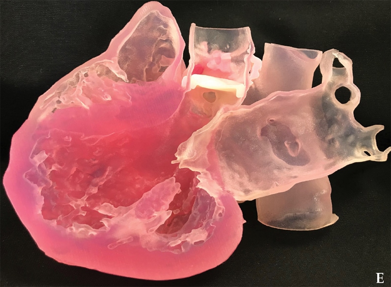 Internal features of the left ventricle and atrium