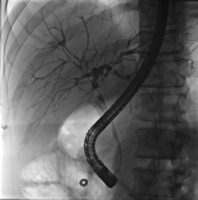 ERCP showing strictures in the hepatic biliary system