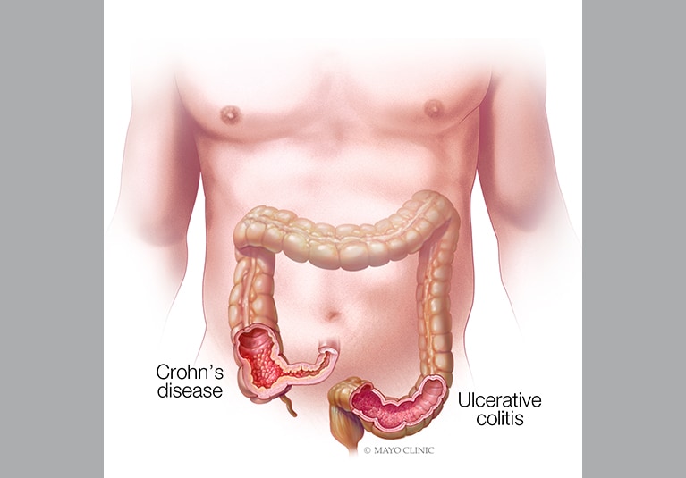 new research crohn's disease