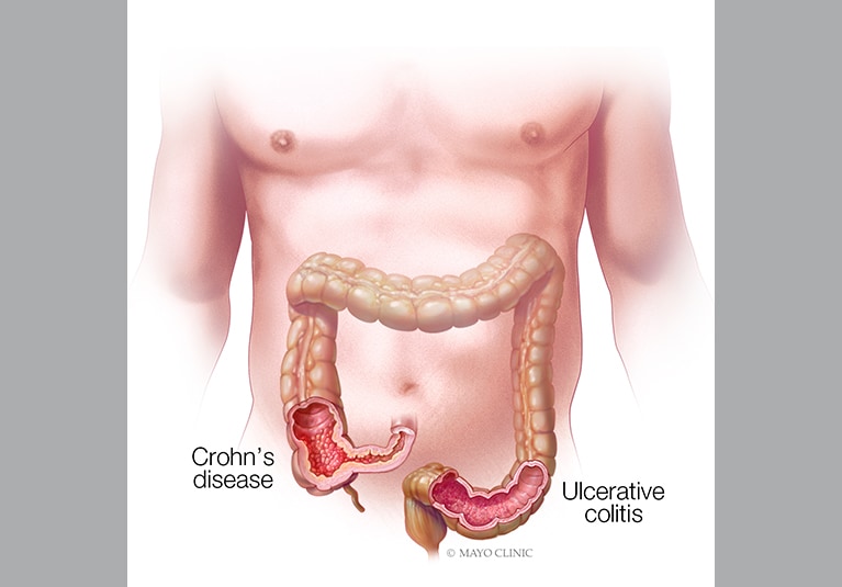 Advances in the treatment of Crohn's disease and ulcerative colitis