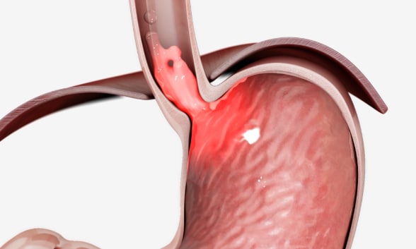 Incompetent gastroesophageal valve function