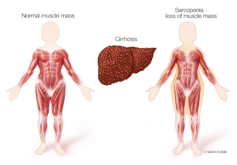 A closer look at sarcopenia and the role of exercise in liver transplant candidates - Mayo Clinic