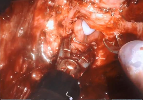 Posterior bladder neck dissection