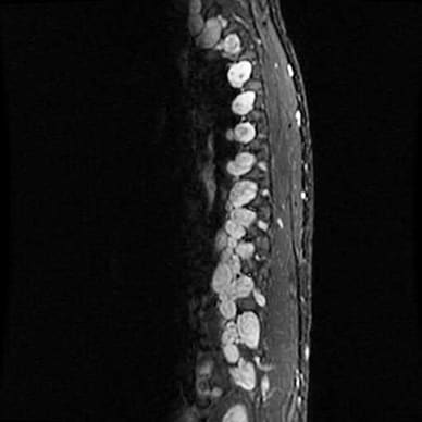 Multiple neurofibromas along thoracolumbar spine in NF1