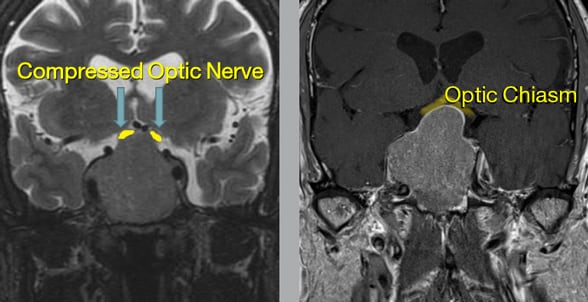 Pituitary tumor compressing the optic nerve