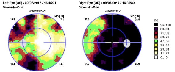 Optometry exam image of near-blindness in the right eye
