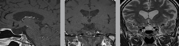 MRI image of pituitary tumor after endoscopic skull base surgery