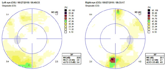 Optometry exam image of vision restored after the tumor resection