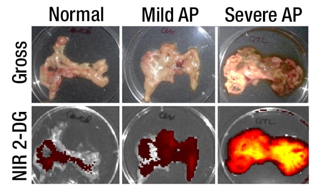 Pancreata with mild and severe acute pancreatitis