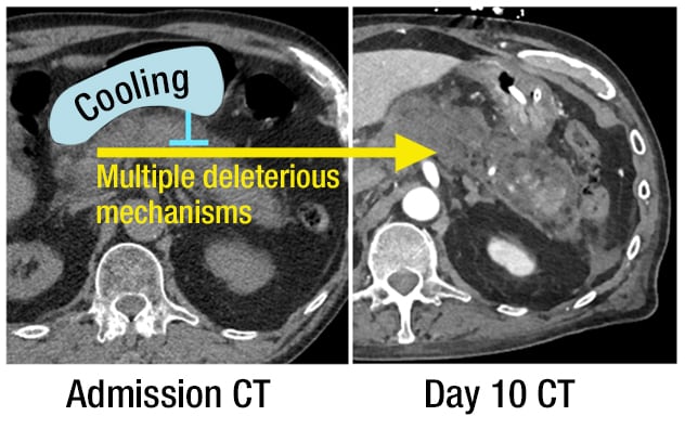 Early transgastric pancreatic cooling