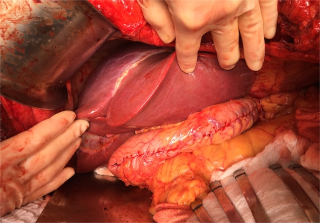 Simultaneous liver transplantation with sleeve gastrectomy