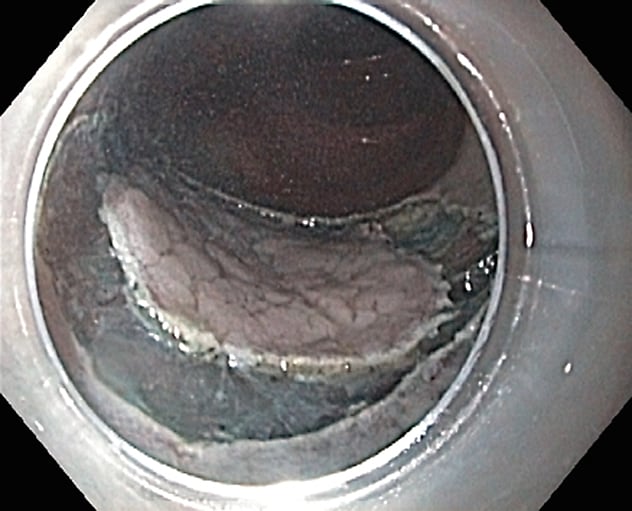 Endoscopic submucosal dissection of a lesion