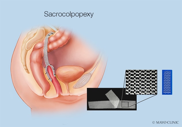 Sacrocolpopexy مع الشبكة