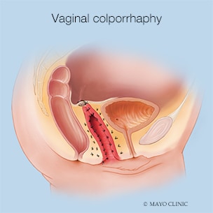 Vaginal colporrhaphy