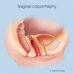 Colporrafia vaginal