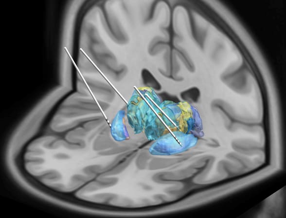 Placement of bipallidal and bithalamic DBS electrodes