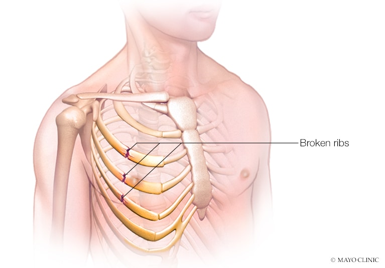 Helping Elderly Patients With Rib Fractures Avoid Serious Respiratory Complications Mayo Clinic