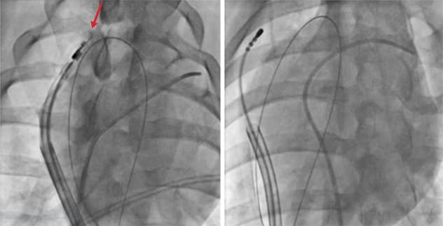 Catheter prototype used for the minimally invasive pericardiectomy