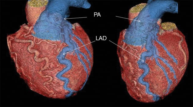 Congenital coronary anomaly