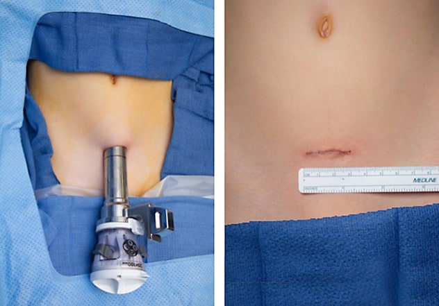 HIdES approach for robotic-assisted dismembered pyeloplasty