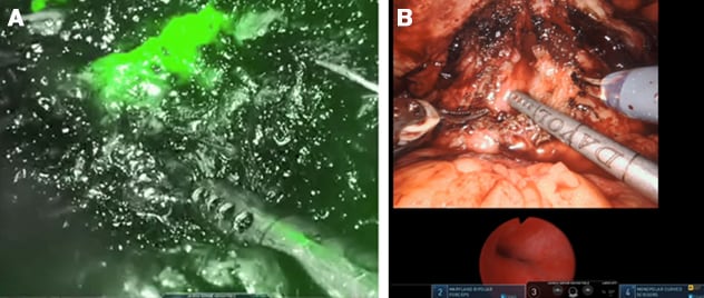 Robotic posterior urethroplasty