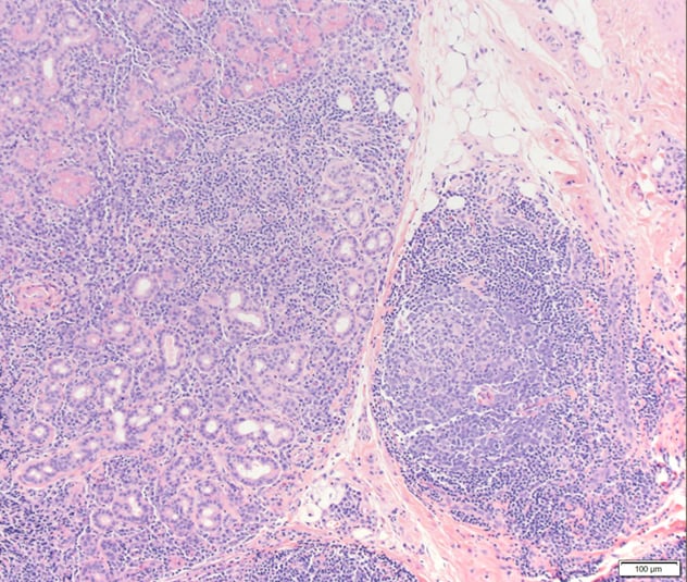 Lacrimal gland biopsy shows extensive reactive lymphoplasmacytic infiltrate