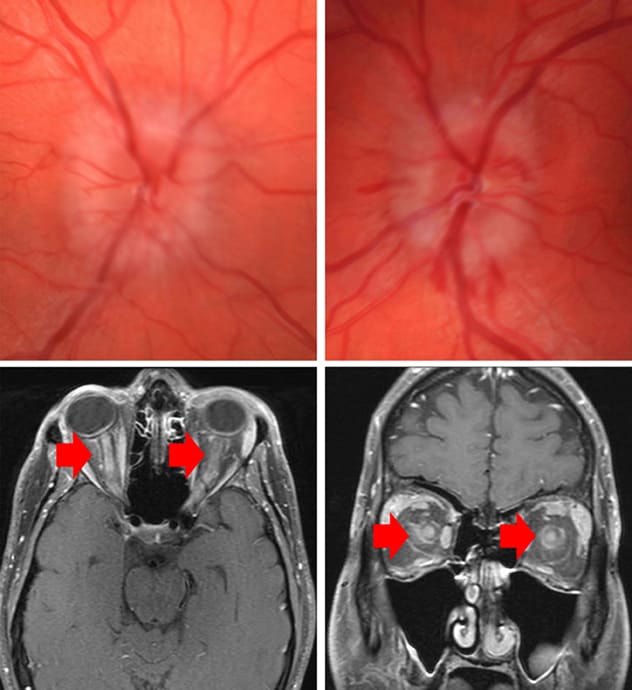 Bilateral grade 3 optic disk edema with peripapillary hemorrhages