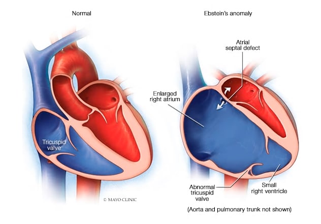 Regurgitación tricuspídea y miopatía del ventrículo derecho