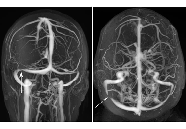 Imágenes de la estenosis del seno venoso transverso obtenidas por venografía por resonancia magnética (indicada por flechas)