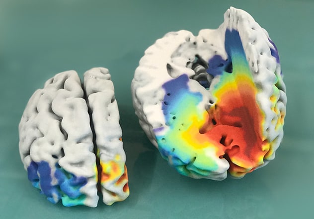 Human brain with glioblastoma
