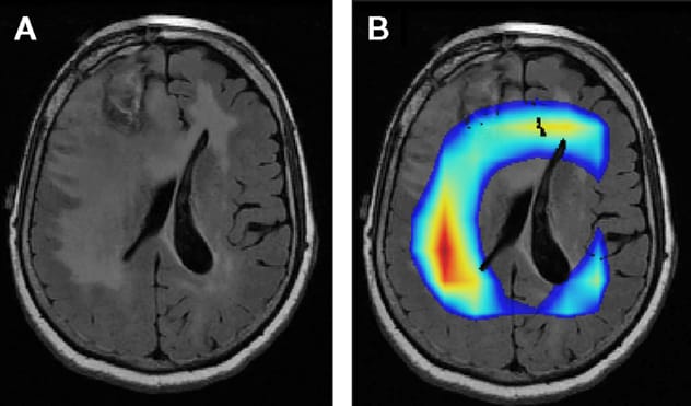 MRI of brain tumor