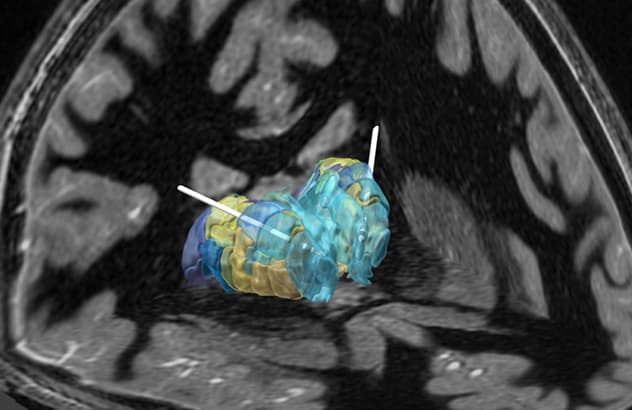 Precise electrode placement and programming