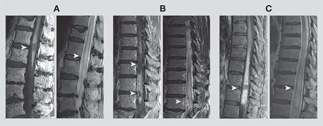 Imaging of dAVFs illustrates the missing-piece pattern