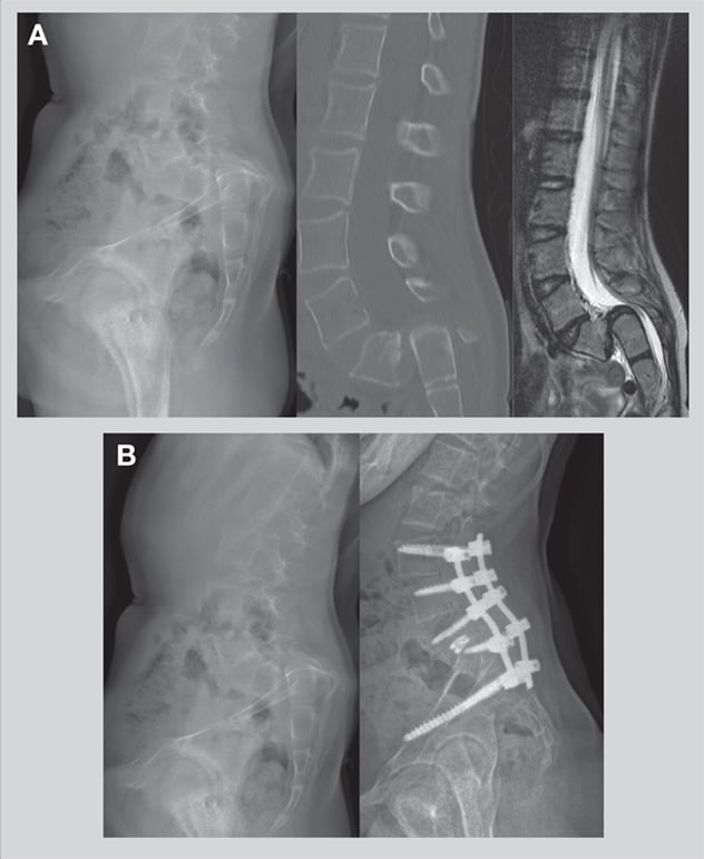 Misalignment and nearly normal alignment of grade 5 spondylolisthesis of L5 on the sacrum