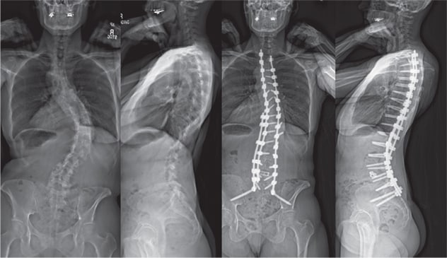 X-rays show spinal curvature, pre- and post-spinal fusion