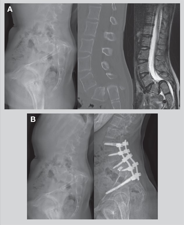 Spinal hardware inserted during L4-S1 transforaminal lumbar interbody fusion