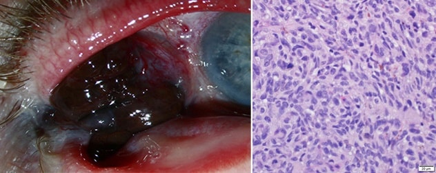 Invasive conjunctival malignant melanoma