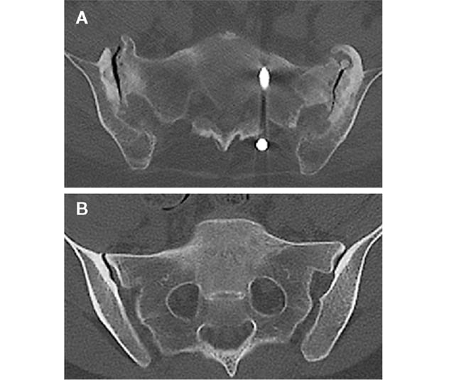 Differing presentations of severe sacroiliac joint pain