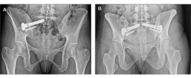 amplitude Opførsel lovgivning Back pain after back surgery: The SI joint and adjacent segment disease -  Mayo Clinic