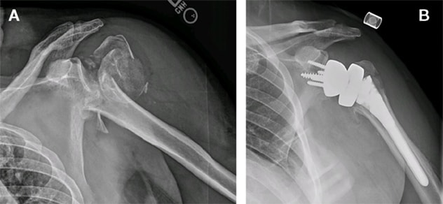 Imágenes de radiografía de la fractura humeral proximal antes y después del tratamiento