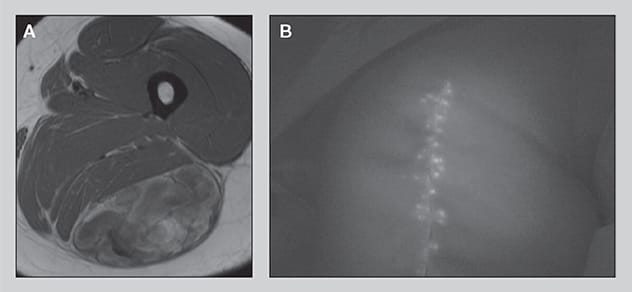 Posterior thigh myxoid liposarcoma