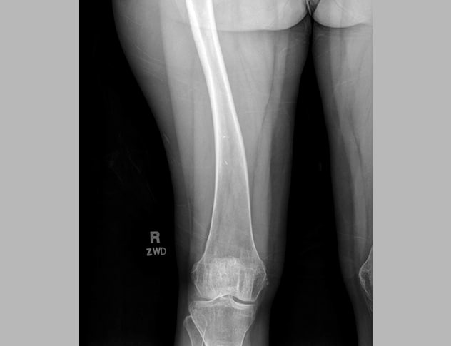 Plain radiograph demonstrating bowing of right femur