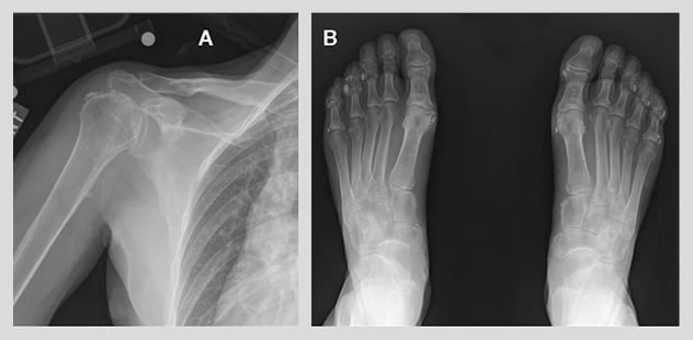 Plain radiographs demonstrating periarticular calcifications