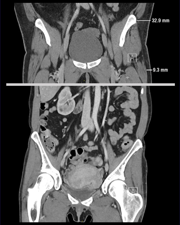 Coronal CT images of cases 2 and 3